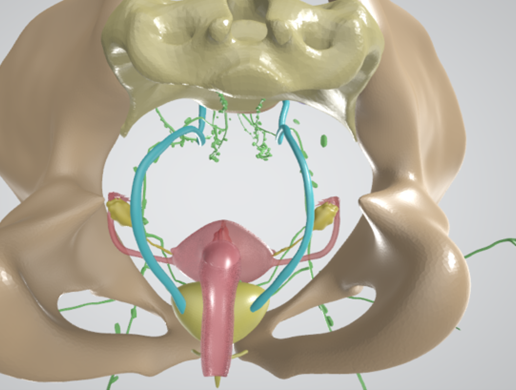 CERVICAL-CANCER-4.png 3D CÁNCER DE CUELLO UTERINO CON ÚTERO, GANGLIOS LINFÁTICOS, SISTEMA URINARIO, VÉRTEBRAS Y PELVIS