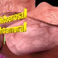 0012.jpg Fibroid Uterus Human female 3D