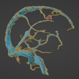 uv19.png 3D Model of Brain Arteriovenous Malformation
