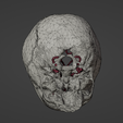 t3.png 3D Model of Middle Cerebral Artery (MCA) Aneurysm