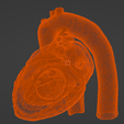 6.png 3D Model of Heart with Tetralogy of Fallot (ToF)