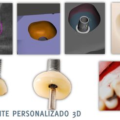 MODULO I INTRO .jpg STL-Datei SCAR PLUG, BASE FOR GENERATING EMERGENCY PROFILE・Design für den 3D-Druck zum Herunterladen