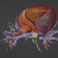 6.png 3D Model of Heart (from real patient)