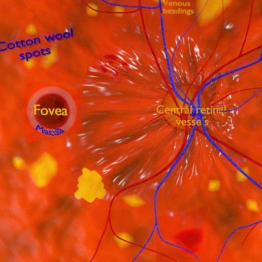 dm4058.jpg Diabetic eye diseases model
