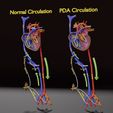 ps-0002.jpg PDA Patent Ductus Arteriosus vs Normal blood circulation