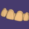 Clipboard-2024-12-21-00-37-41-1.jpg DIGITAL FLEXIBLE UPPER PARTIAL DENTURE  (3D models !!!) - 7 stl files for download)