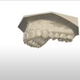 Screenshot_29.png Digital Full Coverage Occlusal Splint with Canine Guidance