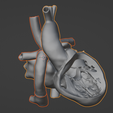 17.png 3D Model of Heart after Fontan Procedure