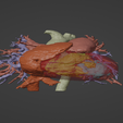 1.png 3D Model of Human Heart with Patent Ductus Arteriosus (PDA) - generated from real patient