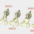 normal pelvis GRADE 2A GRADE 2C GRADE 3B ic . , x ae a GRADE 2B Z =< GRADE 3A Paprosky Classification of Acetabular Bone Loss