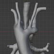 28.png 3D Model of Double Aortic Arch