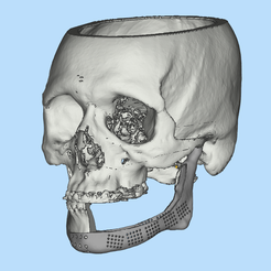 1.png Fichier STL Implant mandibulaire - PROSTHÈSE INDIVIDUELLE POUR LA RECONSTRUCTION DE LA MÂCHOIRE・Modèle à imprimer en 3D à télécharger