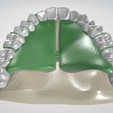 Removable-Palatal-Expansion-Appliance,-molar-distalizer,-teeth,-dental,-tooth,-palatal-expander,-app.png Aparato de Expansión Palatal Removible (KDE) en Dientes Superiores Aparato Dental