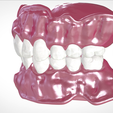 Screenshot_17.png STL file Digital Full Dentures for Gluedin Teeth with Manual Reduction・3D printable design to download