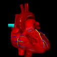 1.png 3D Model of Partial Anomalous Pulmonary Venous Connection