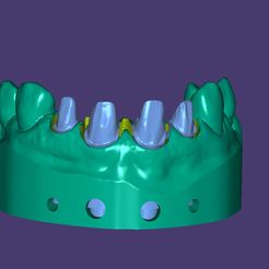 Capture.jpg STL-Datei Zahnmodell mit abnehmbaren Stümpfen im Frontzahnbereich und Brückenkappe・3D-druckbares Modell zum Herunterladen