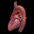 3.jpg 3D Model of Heart with Atrial Septal Defect