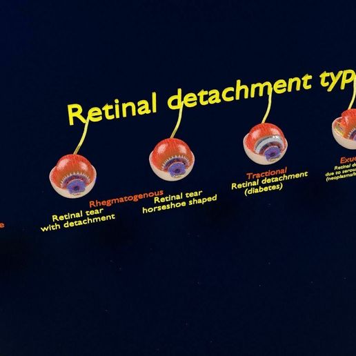 retinal-detachment-types-eye-3d-model-blend-69.jpg Retinal detachment types eye 3D model