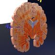 ps31.jpg Alzheimer Disease Brain coronal slice