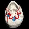i12.jpg 3D Model of Brain Arteriovenous Malformation