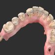 2.jpg colored dental models with periodontitis