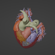 7.png 3D Model of Human Heart with Double Superior Vena Cava (DSVC) - generated from real patient