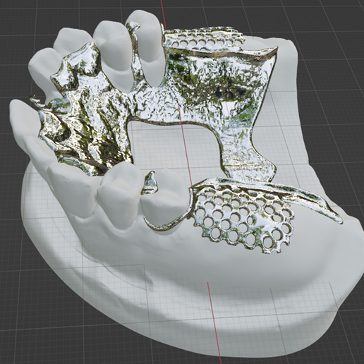 Kennedy-Class-I-Mod-1-Maxillary-12.png Prosthodontics Kennedy Class I Mod 1 Maxillary Removable partial denture (RPD)