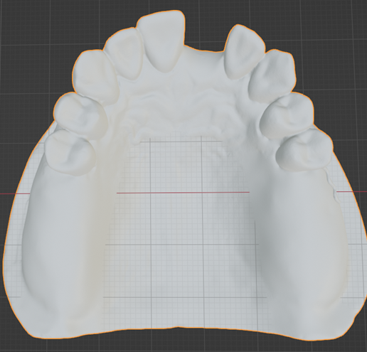 Kennedy-Class-I-Mod-1-Maxillary-8.png Prosthodontics Kennedy Class I Mod 1 Maxillary Removable partial denture (RPD)