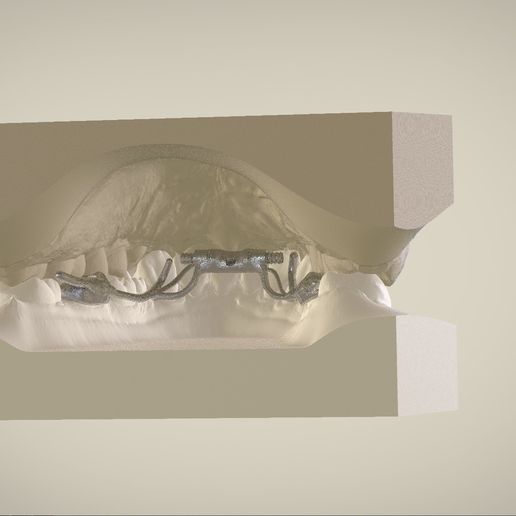 Snapshot_2017-3-1_13-12-56.jpg Digital Dr. Williams's Ortho Appliance