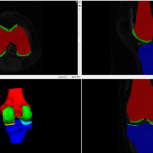🦵 3D Model of Knee - generated from a real patient・ STL File for ・Cults