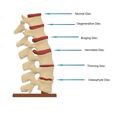 55.jpg Spine defects