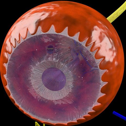 dm1156.jpg Diabetic eye diseases model