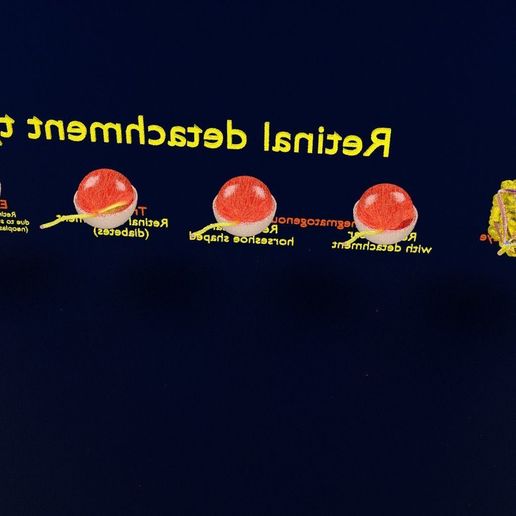 retinal-detachment-types-eye-3d-model-blend-58.jpg Retinal detachment types eye 3D model