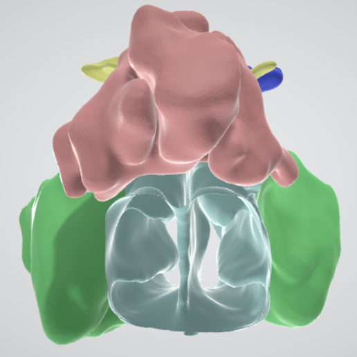 sinus,-nasal,-frontal,-ethmoid,-sphenoid,-orbital,-oral,-dental,-nose,-maxillary,-nerve,-head,-skull.png 通过真实 CT 扫描获得的鼻腔鼻窦高分辨率 3D 解剖图：上颌窦、乙状窦（包括眶上乙状窦）、额窦、鼻腔和三个鼻小柱