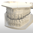 Screenshot_4.png Digital Full Coverage Occlusal Splint with Canine Guidance
