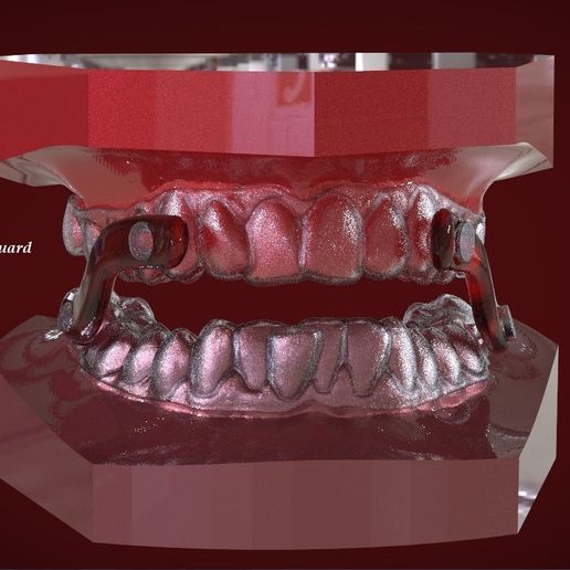 Digital Sleep Apnea Mouthguard