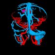 i8.jpg 3D Model of Brain Arteriovenous Malformation