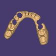 Clipboard-2024-06-11-20-39-52.jpg DIGITAL LOWER PARTIAL REMOVABLE DENTURE - flexible