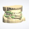 Clipboard-2024-05-06-10-36-41-1.jpg DIGITAL PARTIAL REMOVABLE DENTURES ( upper + lower + 3D MODELS) - flexible