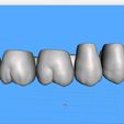 Dentes-Maxila-Ashortia-Exocad-03.jpg Teeth Maxilla - Ashortia - Exocad