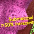 0009.jpg Fibroid Uterus Human female 3D