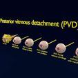 posterior-vitreous-detachment-types-eye-3d-model-blend-47.jpg Posterior vitreous detachment types eye 3D model