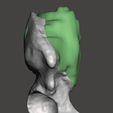Preview2.png Sarcoma pélvico impreso en 3D