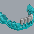 geller-1.png Geller dental model for veneer practice