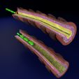 sig.jpg 3D Asthma bronchiole obstruction model