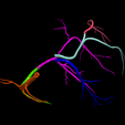 11.png 3D Model of Bicuspid Aortic Valve (BAV)