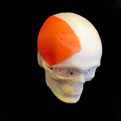 IMG_7809.JPG STL-Datei Craniofacial Implant 3d print model・3D-druckbares Modell zum herunterladen