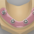 download.png Screw retained abutments