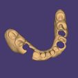 Clipboard-2024-06-11-20-40-02.jpg DIGITAL LOWER PARTIAL REMOVABLE DENTURE - flexible