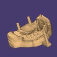 Clipboard-2024-12-21-00-32-18.jpg DIGITAL FLEXIBLE PARTIAL DENTURES upper + lower (3D models !!!) - 10 stl files for download